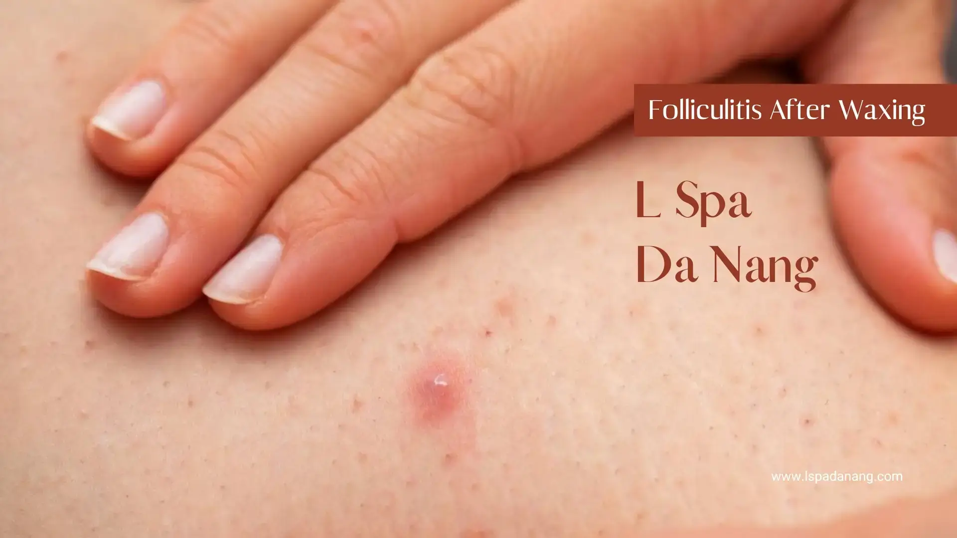 Folliculitis After Waxing
