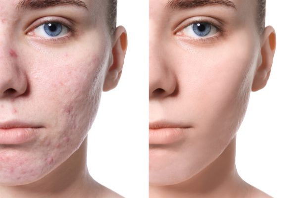 Acne Treatment Guide | How To Treat Acne And Control It? 13 before and after acne treatment
