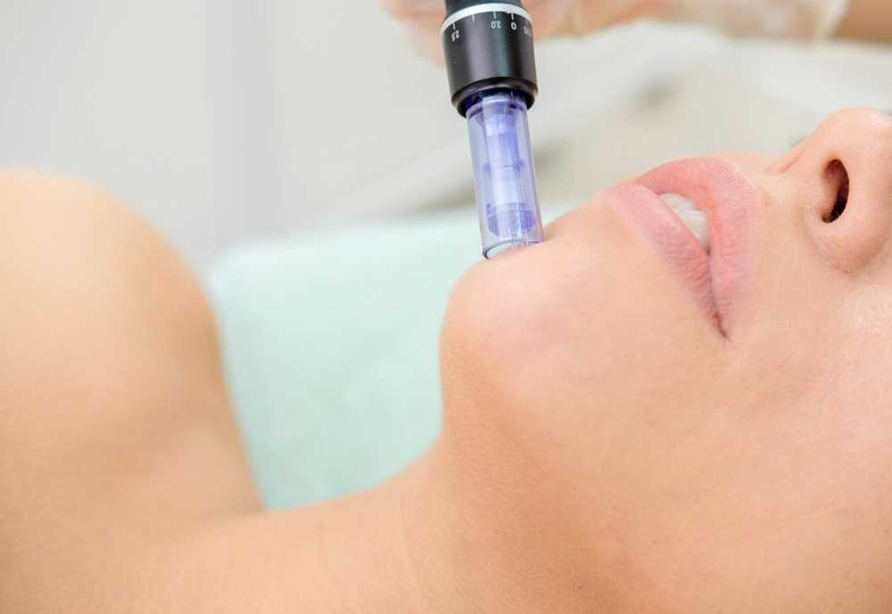 Microneedling - Unlocking the Secrets to Radiant Skin 4 Is Microneedling Safe for Everyone?