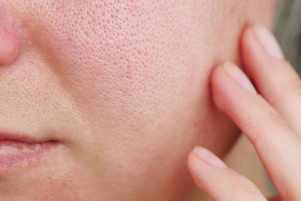 How To Close Open Pores on Face? Facial Treatment for Pores 2 What Are The Types Of Open Pores?