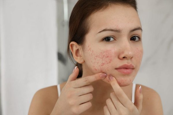 What is Azelaic Acid? The benefists of Azelaic Acid for Acne 3 What Are The Possible Side Effects When Using Azelaic Acid
